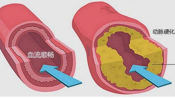 如何改善动脉硬化，成都金牛区养老院一暄康养为您介绍-动脉硬化